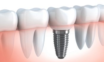 Norwalk Implant Center